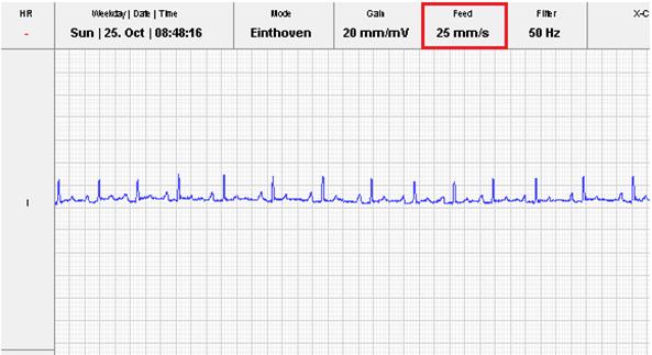 ecg